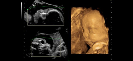 Поверхностная реконструкция лица плода с помощью технологии SonoRenderlive