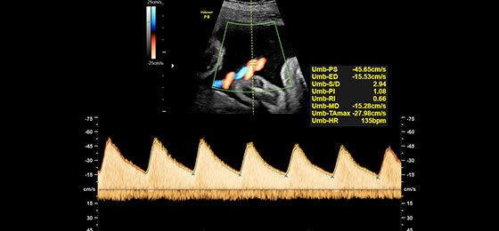 Допплеровский спектр в пуповине плода