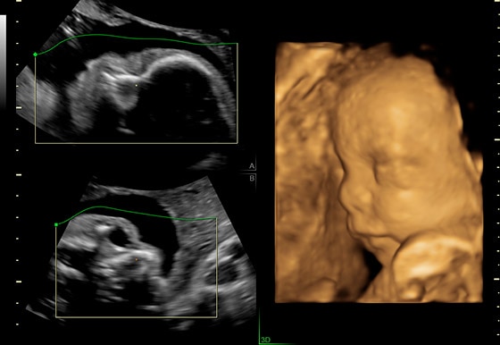 voluson-performance-p8_s-curve-module_sonorenderlive