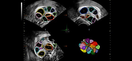 Оценка фолликулярного аппарата яичника с помощью полуавтоматической технологии SonoAVCfollicle