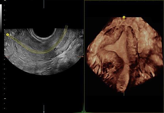 voluson-s8-signature-series-ge-s-curve-advanced-volume-contrast-imaging