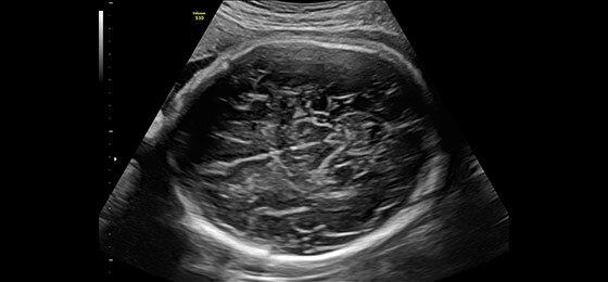 Мозг 29-недельного плода