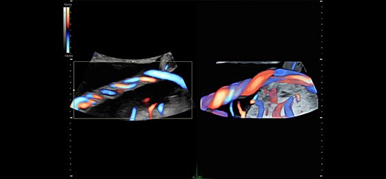 Визуализация пуповины с помощью функции 3D Glassbody
