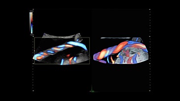 Визуализация пуповины с помощью функции 3D Glassbody