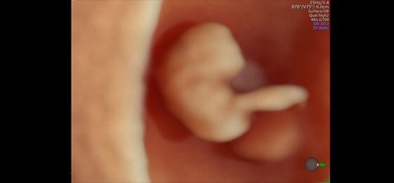 8-недельный плод, HDlive™