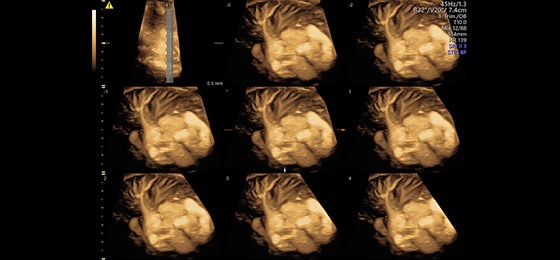 Сердце и легкие в режиме B-Flow с применением функций TUI и VCI