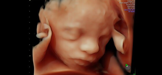 Визуализация лица плода с помощью HDlive™