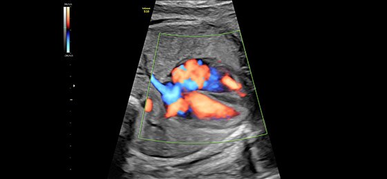 Сердце плода в режиме HD-Flow™