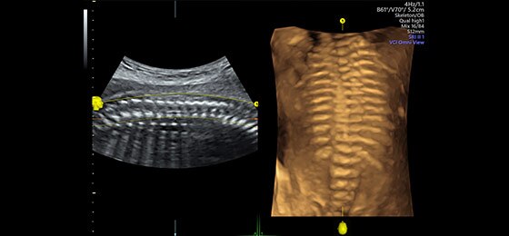 Позвоночник плода, реконструированный с помощью функции OmniView