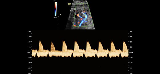 HD-Flow и импульсно-волновой допплер почки плода