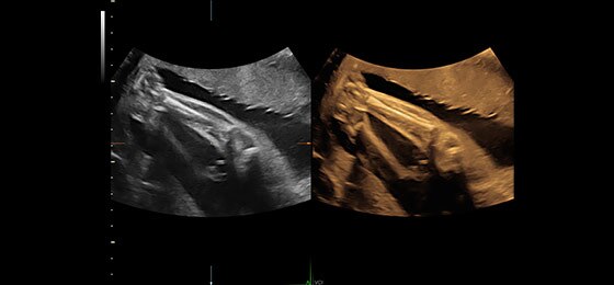 Кости голени, визуализируемые с помощью VCI-A