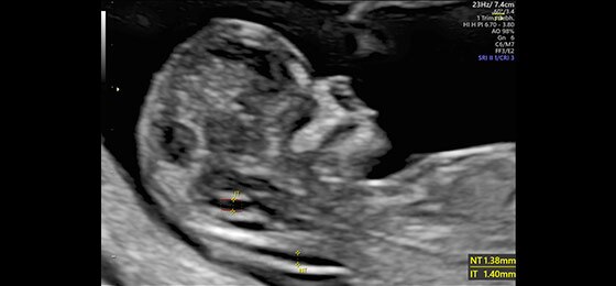 Измерение толщины воротникового пространства и интракраниального пространства с помощью систем SonoNT™ и SonoIT