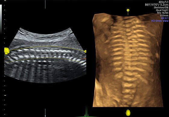 voluson-s10-ge-s-curve-3d-images-volume-contrast-imaging-omniview
