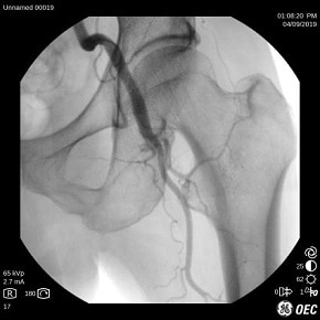 OEC One CFD Hip - 290 pixels