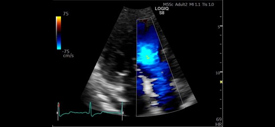 Цветной допплер в кардиологии, M5S-D