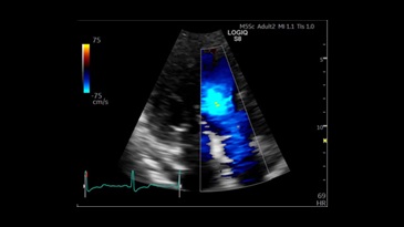 Цветной допплер в кардиологии, M5S-D