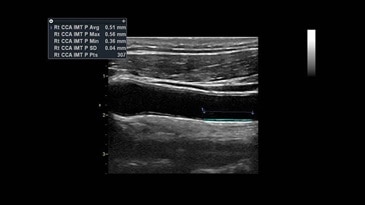 Автоматическое измерение толщины комплекса интима-медиа*