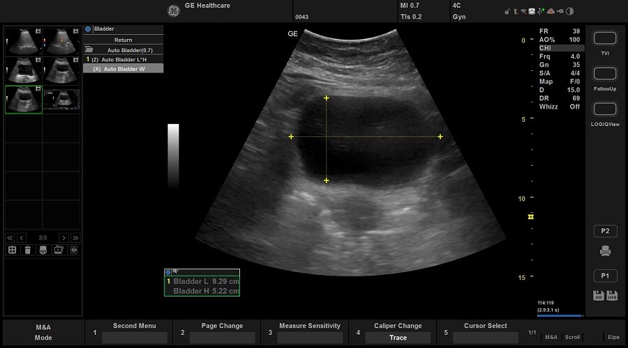 Автоматическое измерение размеров мочевого пузыря