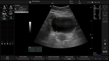 Автоматическое измерение размеров мочевого пузыря