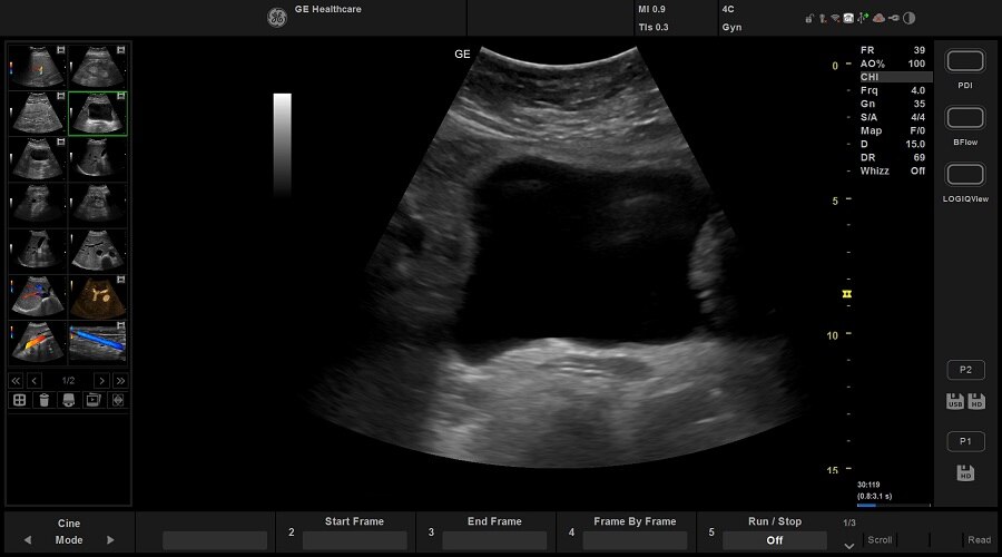 Мочевой пузырь