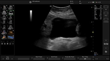 Мочевой пузырь