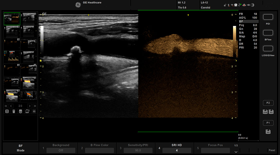 B-flow - режим недопплеровской визуализации кровотока