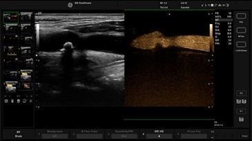 B-flow - режим недопплеровской визуализации кровотока