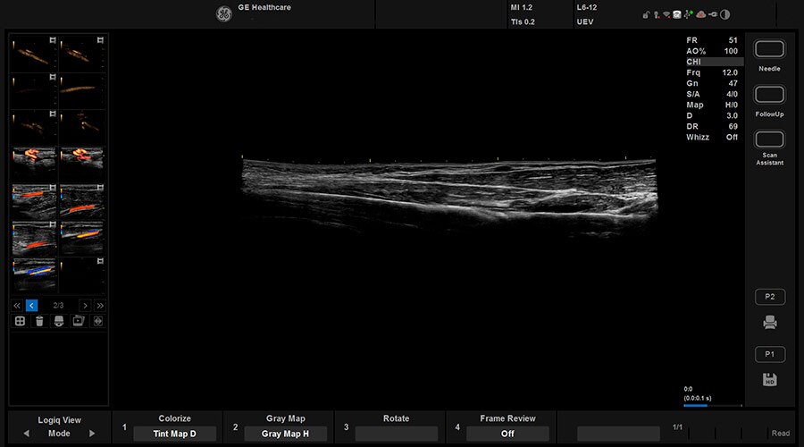 LOGIQ View - панорамное сканировани