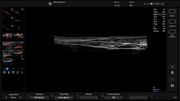LOGIQ View - панорамное сканировани