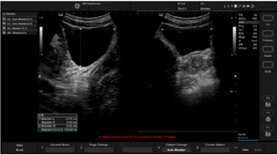 Whizz Bladder – Автоматическое измерение размеров мочевого пузыря
