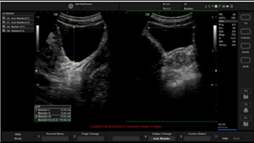 Whizz Bladder – Автоматическое измерение размеров мочевого пузыря