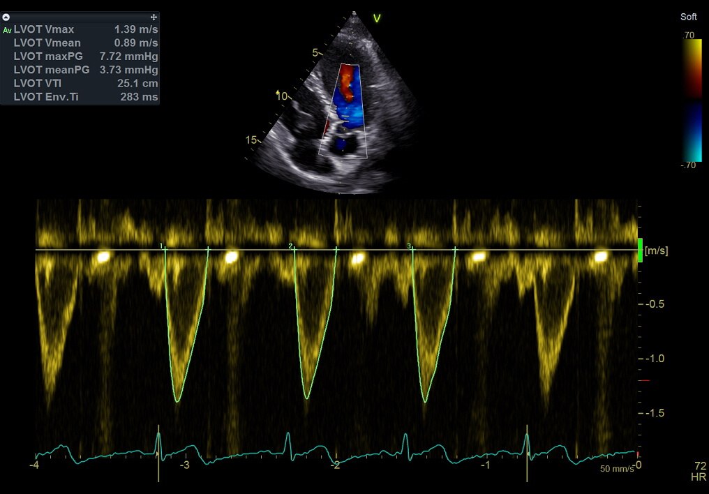 Cardiac Auto Doppler