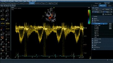 Cardiac Auto Doppler