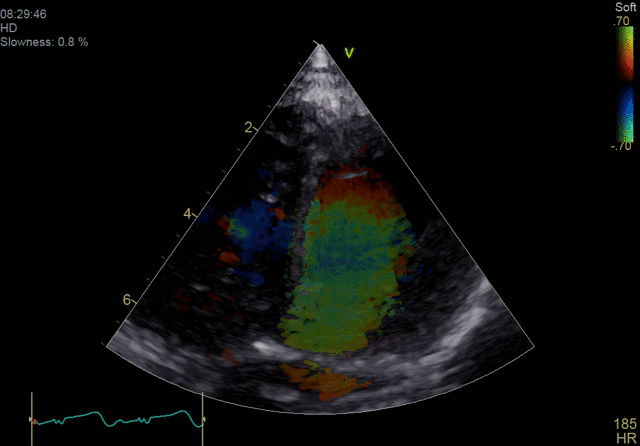 Недопплеровская визуализация кровотока (BSI)