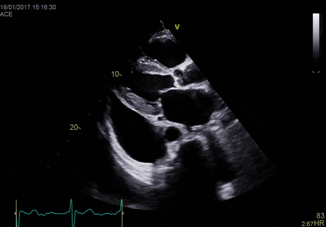 Функция True Confocal Imaging (TCI) (конфокальной визуализации)
