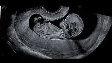 13-week fetal profile