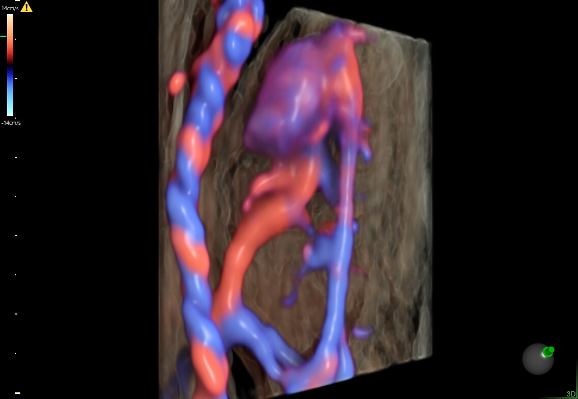 Система кровообращения плода, 15 недель, с помощью eSTIC и HD-Flow™