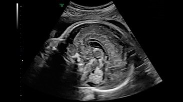 Мозолистое тело и червь мозжечка, 27 недель