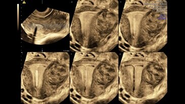 Коронарная плоскость матки, внутриматочная спираль в сочетании с миомой матки, технология Omniview