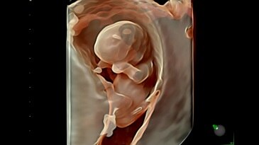 Внутримозговые структуры в ранние сроки, технология HDlive Silhouette