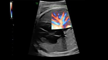 Легочные сосуды, режим HD-Flow, 28 недель