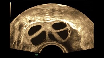 Стимулированные фолликулы яичников