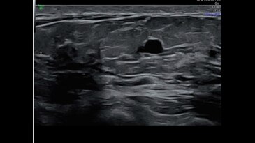 Кистозное образование молочной железы