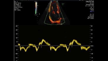 Спектральная допплерограмма в режиме тканевой допплерографии