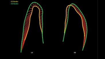 Сократимость сердца плода, представленная с помощью fetalHQ