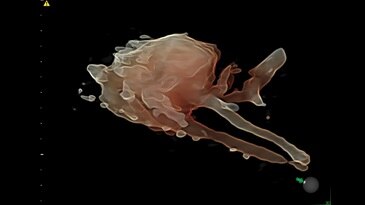 Кровеносная система плода, технология STIC+B-Flow