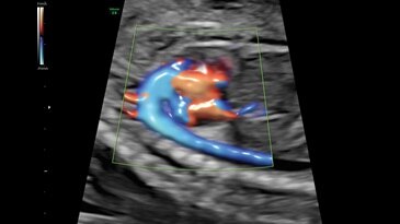 Дуга аорты, 22 недели, режим Radiantflow