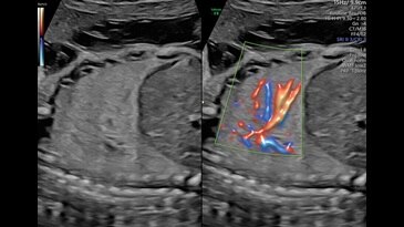 Сосуды легких плода в режиме Radiantflow