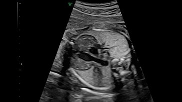 Тимус плода в 26 недель