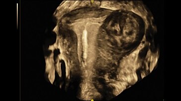 Внутриматочный контрацептив и миома матки с помощью технологии Omniview